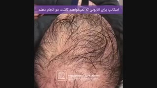 میکرواسکالپ راه حل جایگزین کاشت مو