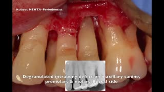 درمان بیماری پریودنت قبل از جراحی|کلینیک دندانپزشکی مدرن