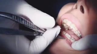 ویدیو ارتودنسی سرامیکی در دندانپزشکی|کلینیک مدرن