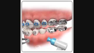 شکستن براکت ارتودنسی | دکتر قریشی