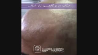 اسکالپ جایگزین مناسب پوستیژ