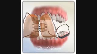 دستگاه اکسپندر | دکتر قریشی