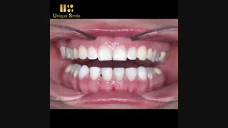 اصلاح طرح لبخند | دکتر عطایی
