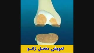 انیمیشن تعویض مفصل زانو | دکتر مسعود صابری برداشتن توده