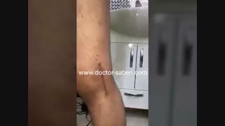 یست روز بعد از عمل جراحی موفق پارگی چند رباط زانو همزمان