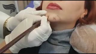 تزریق ژل و بوتاکس