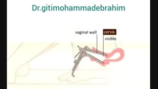 لابیاپلاستی چگونه انجام می شود؟