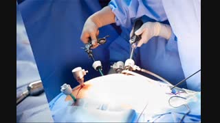 فیلم لیپوماتیک شکم و پهلو - 09122167875