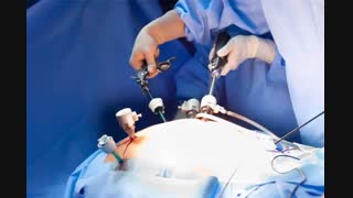 تخلیه چربی های موضعی بدن - 09122167875