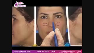 عمل بینی گوشتی توسط دکترکاوان