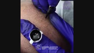 ترمیم اسکالپ در آکادمی ایران اسکالپ