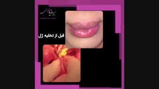 تخلیه ژل پاژ | دکتر ماریا مرادی