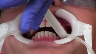 نحوه چسباندن براکت در درمان ارتودنسی|کلینیک دندانپزشکی مدرن