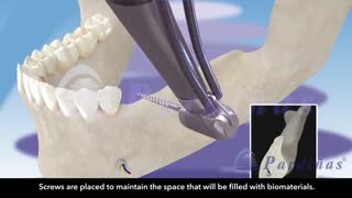 پیوند استخوان درجراحی ایمپلنت با متد جدید|کلینیک دندانپزشکی مدرن