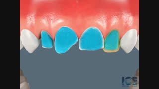 درمان لمینیت به صورت انیمیشن|کلینیک دندانپزشکی مدرن