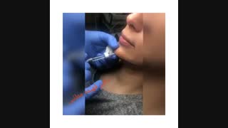 تزریق ژل به چانه کلینیک لیزر