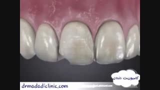 کامپوزیت دندان