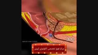سرطان پروستات