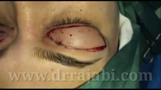 فیلم کامل جراحی بلفاروپلاستی