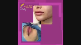 فیلم تزریق ژل به چانه