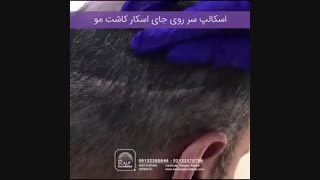 اسکالپ جای اسکار کاشت مو
