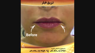 فیلم تزریق فیلر به لب