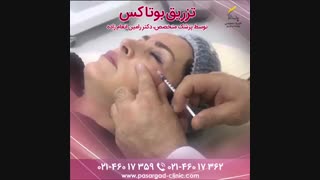 تزریق بوتاکس دور چشم