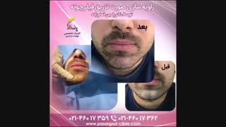 زاویه سازی صورت با تزریق ژل