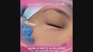 از بین بردن تیرگی دور چشم