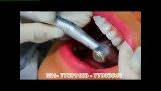 فیلم کامپوزیت ونیر در کلینیک دندانپزشکی شرق تهران