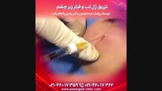 تزریق فیلر زیر چشم