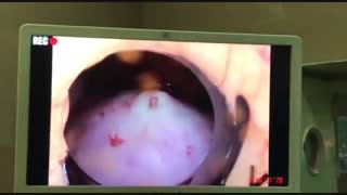 در آوردن رحم به روش لاپاراسکوپی