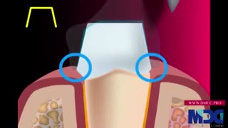 روکش دندان به جهت زیبایی|کلینیک دندانپزشکی مدرن