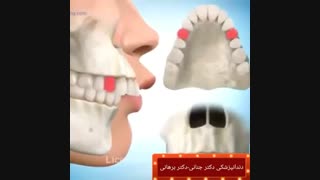 درمان جلو بودن دندان های بالا