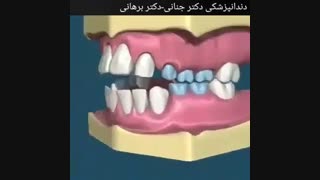 عوارض مکیدن انگشت در کودکان