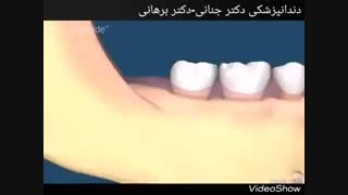 عوارض دندان عقل نهفته