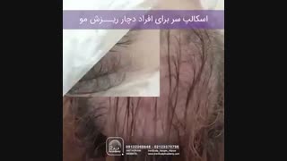 اسکالپ سر در ایران اسکالپ