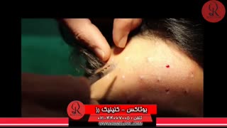 تزریق بوتاکس | فیلم تزریق بوتاکس | کلینیک پوست و مو رز15