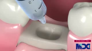 بازسازی استخوان تحلیل رفته