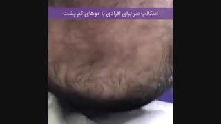 اسکالپ برای افراد دارای ریزش مو