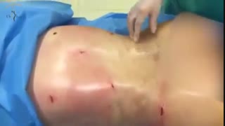 لیپوماتیک پشت کمر و پهلو | دکتر مریم شریفی پروتز دندان