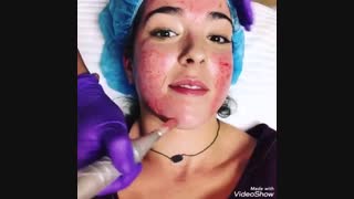 میکرونیدلینگ صورت چگونه است؟ پریودنتیکس