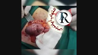 التهاب آپاندیس