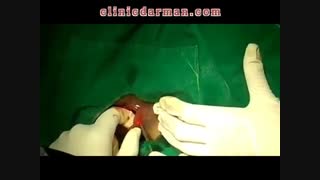 درمان فیستول با لیزر و احتمال بازگشت مجدد فیستول