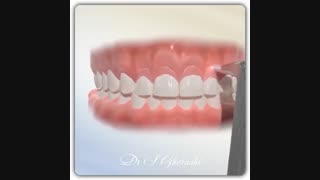 افزایش طول تاج دندان | دکتر قریشی