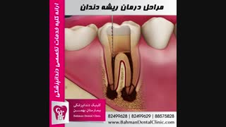 مراحل درمان ریشه دندان | بیمارستان بهمن