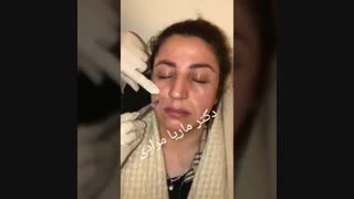 تزریق ژل به خط خنده | دکتر ماریا مرادی
