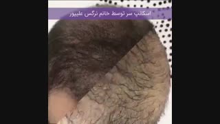 اسکالپ برای افراد دارای ریزش مو
