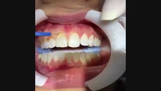 اصلاح طرح لبخند-دکترمجیدقیاسی دندانپزشک زیبایی مشهد