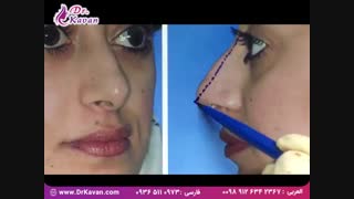 جراحی زیبایی بینی